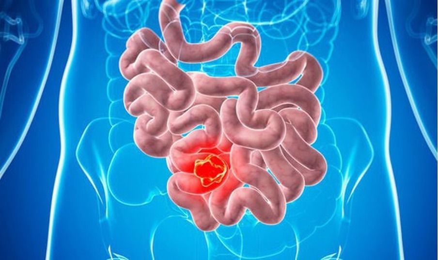 dấu hiệu đi đại tiện cảnh báo ung thư đại trực tràng y duoc thai nguyen