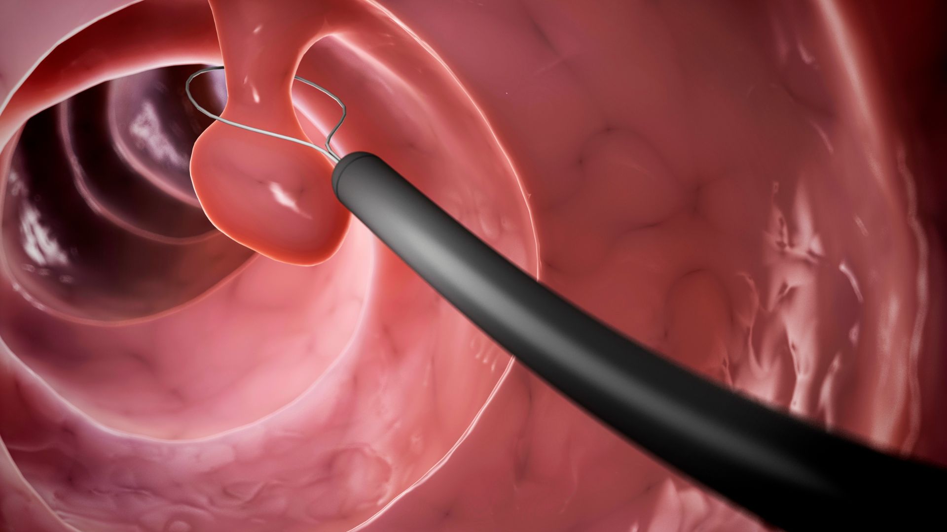 phát hiện polyp khi đi vệ sinh y duoc thai nguyen