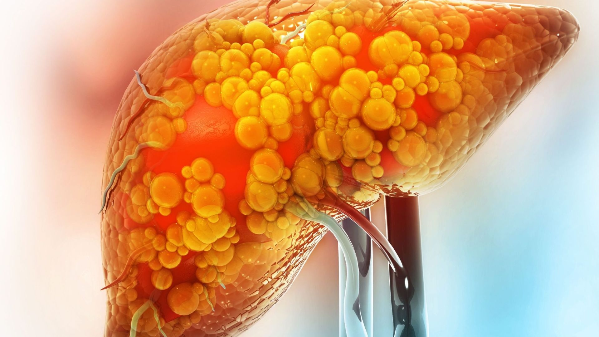 gan nhiễm mỡ làm tăng ung thư gan y duoc thai nguyen