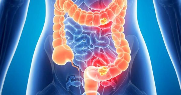 ung thư đại trực tràng y duoc thai nguyen