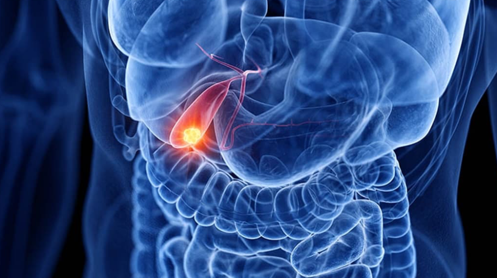 ung thư túi mật y duoc thai nguyen