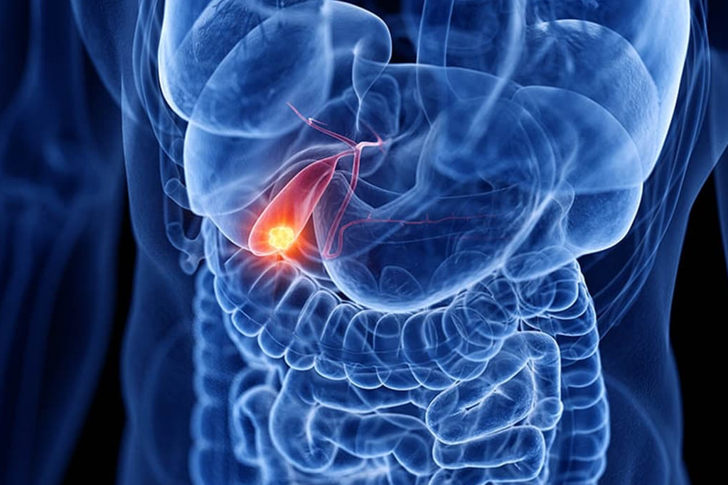 ung thư túi mật y duoc thai nguyen