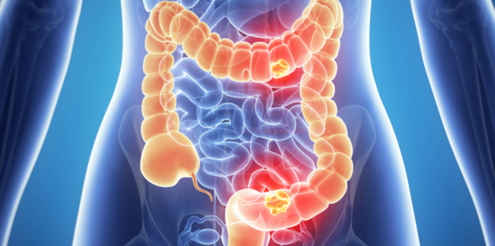 vi khuẩn ẩn  trong ruột phát hiện sớm ung thư y duoc thai nguyen