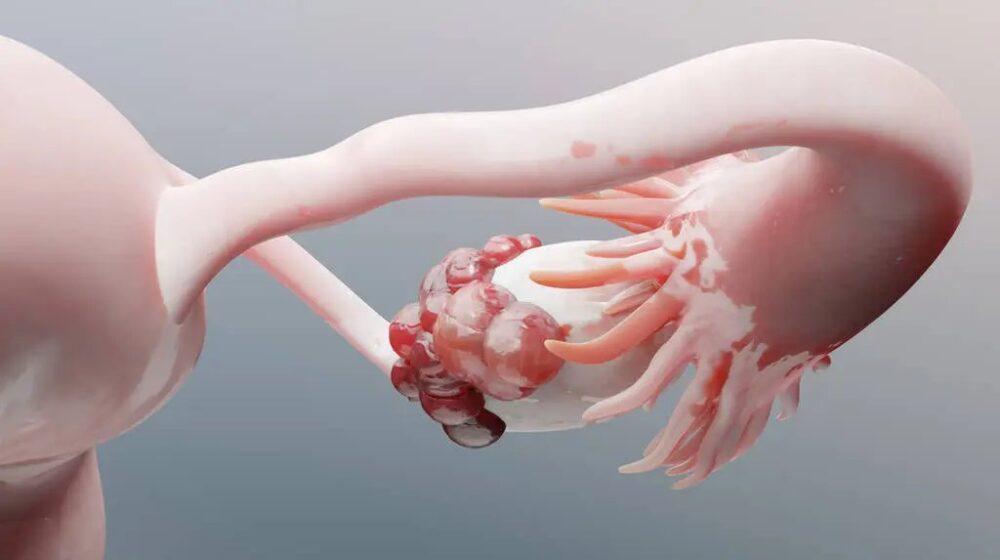 dấu hiệu cảnh báo sắp bị ung thư buồng trứng y duoc thai nguyen