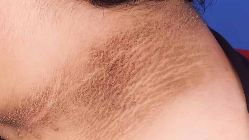 hội chứng buồng trứng đa nang y duoc thai nguyen