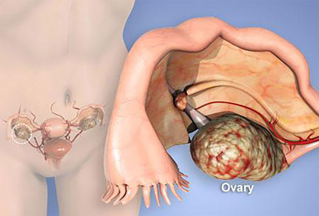 ung thư buồng trứng y duoc thai nguyen
