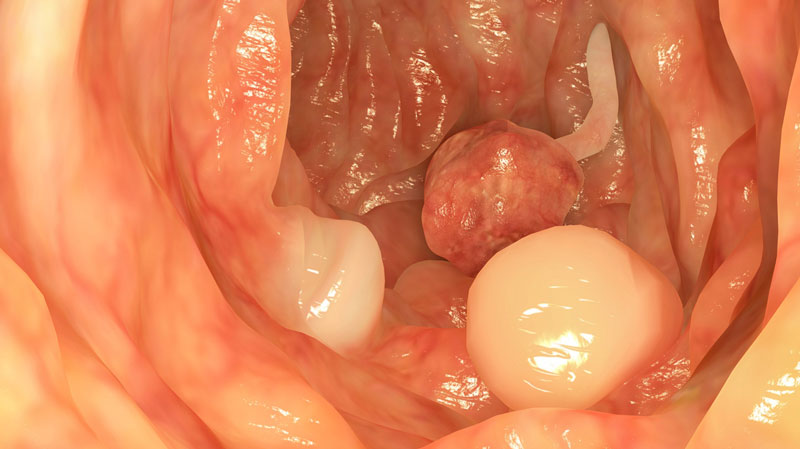 nhận biết ruột có polyp y duoc thai nguyen