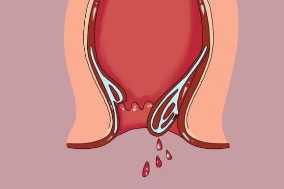 nhận biết ruột có polyp y duoc thai nguyen