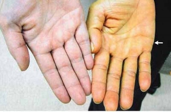 ung thư túi mật y duoc thai nguyen