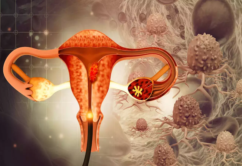 ung thư buồng trứng sau tuổi mãn kinh y duoc thai nguyen